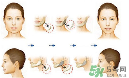 瘦臉針進(jìn)口好還是國(guó)產(chǎn)好？瘦臉針國(guó)產(chǎn)和進(jìn)口的區(qū)別