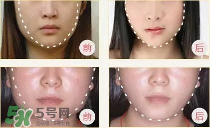 打完瘦臉針多久可以化妝？打完瘦臉針的反應