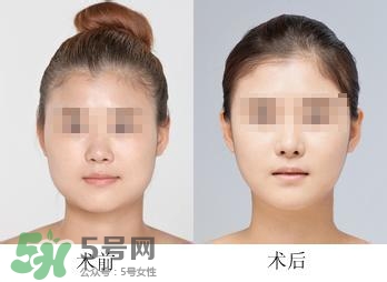 打瘦臉針能喝酒嗎？打瘦臉針能吃海鮮嗎？