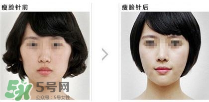 打瘦臉針能喝酒嗎？打瘦臉針能吃海鮮嗎？