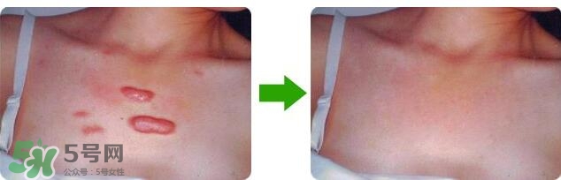 祛疤痕最好的方法有哪些？祛疤痕的簡單方法