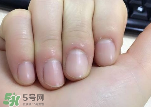 手上長倒刺可以拔嗎?手上長倒刺能拔嗎? 手上長倒刺可以拔嗎?手上長倒刺能拔嗎?