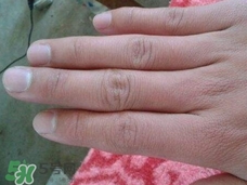 手上長倒刺可以拔嗎?手上長倒刺能拔嗎? 手上長倒刺可以拔嗎?手上長倒刺能拔嗎?