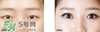開眼角要恢復(fù)多久？開眼角好不好？