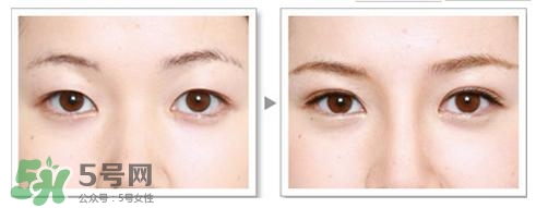 割雙眼皮有什么后遺癥嗎？割雙眼皮有什么危害性？