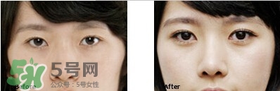 開眼角要恢復(fù)多久？開眼角好不好？