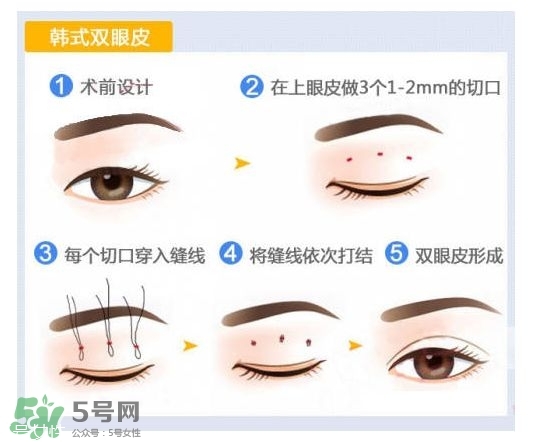 割雙眼皮有幾種做法？雙眼皮有哪幾種形狀？