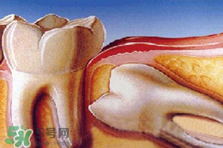 智齒經(jīng)常發(fā)炎怎么辦？智齒反復(fù)發(fā)炎腫痛怎么辦？