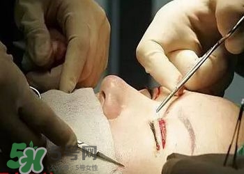 割雙眼皮疼不疼？割雙眼皮疼幾天能好？