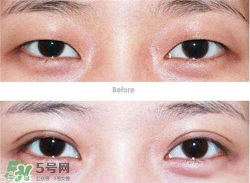 割雙眼皮有幾種做法？雙眼皮有哪幾種形狀？