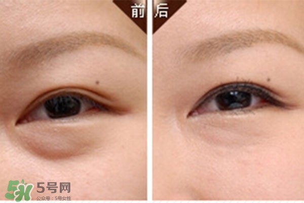 臥蠶是黑眼圈嗎？臥蠶和黑眼圈的區(qū)別