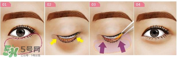 眼袋是怎么形成的？手術去眼袋安全嗎