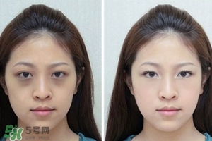 臥蠶是黑眼圈嗎？臥蠶和黑眼圈的區(qū)別