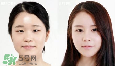 割雙眼皮有什么后遺癥嗎？割雙眼皮有什么危害性？