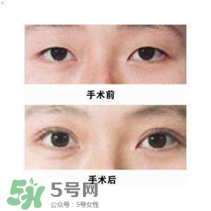 割雙眼皮疼不疼？割雙眼皮疼幾天能好？