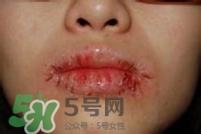 嘴唇干燥是什么原因？嘴唇干裂脫皮怎么辦？