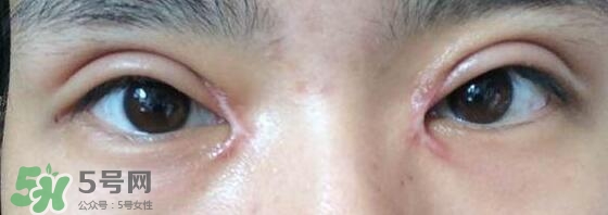 眼角增生是什么意思？眼角增生了怎么辦？