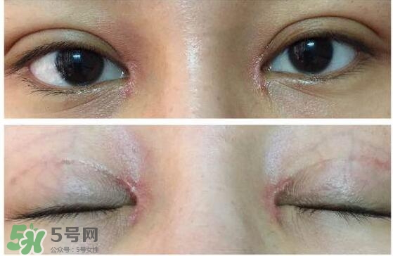 眼角增生是什么意思？眼角增生了怎么辦？