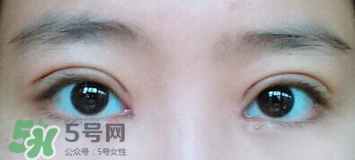 眼角增生會(huì)自動(dòng)恢復(fù)嗎？眼角增生多久可以下去？