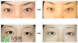 哪些人需要開眼角？需要開眼角的眼睛圖片