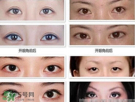 哪些人需要開眼角？需要開眼角的眼睛圖片