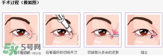 哪些人需要開眼角？需要開眼角的眼睛圖片