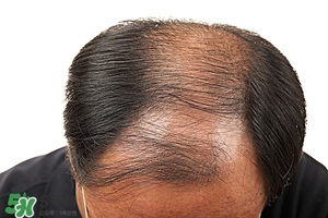脫發(fā)怎么修復(fù) 脫發(fā)嚴(yán)重的原因是什么 脫發(fā)怎么修復(fù) 脫發(fā)嚴(yán)重的原因是什么