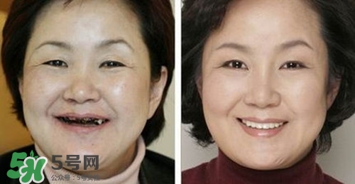 去皺最好的方法 最有效的去皺方法 去皺最好的方法 最有效的去皺方法