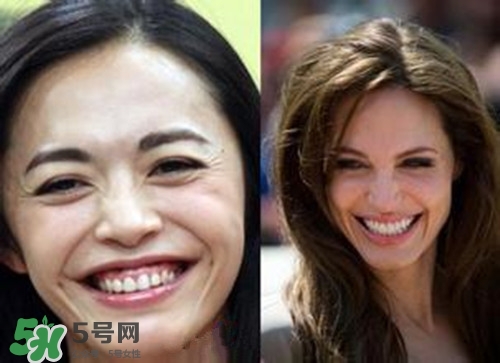 去皺最好的方法 最有效的去皺方法 去皺最好的方法 最有效的去皺方法