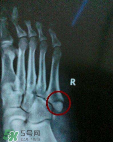 骨裂吃什么好得快？骨裂和骨折的區(qū)別