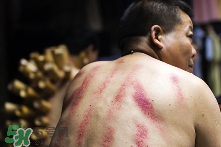 骨質(zhì)疏松可以刮痧嗎？骨質(zhì)疏松刮痧好嗎？