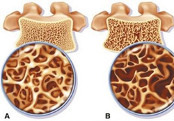 骨質(zhì)疏松要補(bǔ)鈣嗎？骨質(zhì)疏松補(bǔ)什么好？