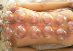 拔火罐有依賴性嗎？拔火罐依賴性強嗎？