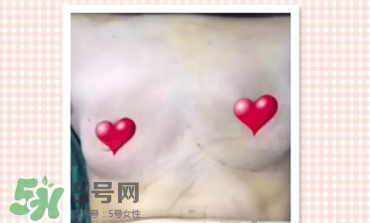 假體隆胸取出后圖片 隆胸假體取一月圖片 假體隆胸取出后圖片 隆胸假體取一月圖片