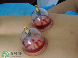 春天可以拔火罐嗎？春天適合拔火罐嗎？