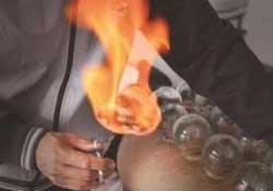 春天可以拔火罐嗎？春天適合拔火罐嗎？