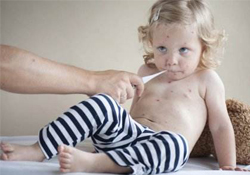 水痘隔離期為多少天？水痘的傳染期是多少天？