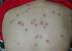 水痘會(huì)發(fā)燒嗎？小孩出水痘發(fā)燒怎么辦？