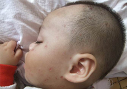 有水痘的寶寶能不能沾水？長水痘可以碰水嗎？