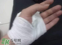 傷口化膿怎么處理？傷口化膿用什么藥好？