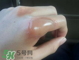 燙傷可以用牙膏嗎？燙傷用牙膏管用嗎？