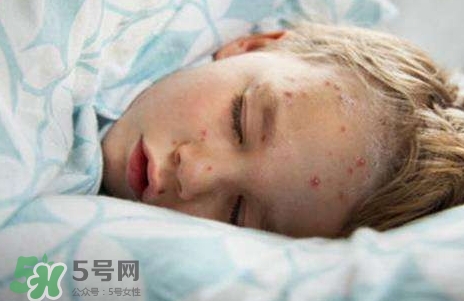 長(zhǎng)水痘可以吃雞蛋嗎?得水痘能吃雞蛋嗎? 長(zhǎng)水痘可以吃雞蛋嗎?得水痘能吃雞蛋嗎?