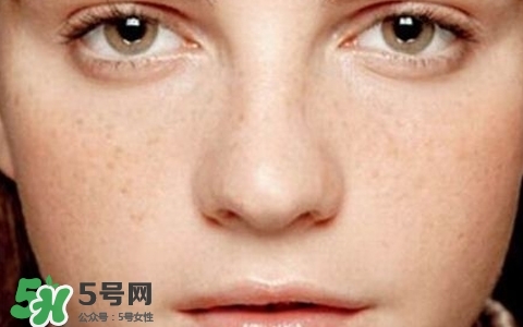 長(zhǎng)斑是什么原因引起的？祛斑效果最好的方法