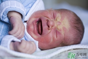 病理性黃疸孩子有何癥狀 病理性黃疸的特點(diǎn) 病理性黃疸孩子有何癥狀 病理性黃疸的特點(diǎn)