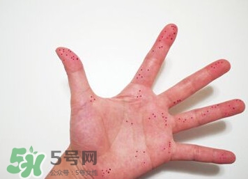 切辣椒后手很辣怎么辦？切辣椒后手很辣多久能好