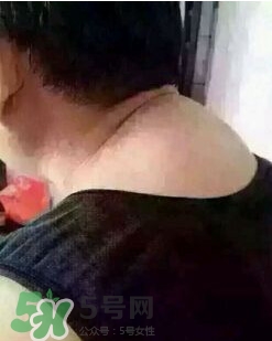 刮痧之后可以艾灸嗎？刮痧之后可不可以艾灸