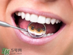 補(bǔ)牙洞需要幾次完成?補(bǔ)牙洞需要多長時間? 補(bǔ)牙洞需要幾次完成?補(bǔ)牙洞需要多長時間?