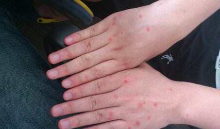 身上紅疙瘩是什么？身上紅疙瘩不痛不癢