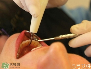 拔牙疼嗎 拔牙疼不疼 拔牙疼嗎 拔牙疼不疼