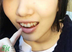 帶牙套會(huì)影響嘴型嗎?帶牙套會(huì)改變嘴型嗎? 帶牙套會(huì)影響嘴型嗎?帶牙套會(huì)改變嘴型嗎?